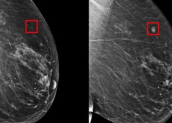 Inteligencia artificial sería capaz de detectar el cáncer de mama 4 años antes de formarse