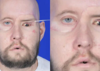 Realizan con éxito primer trasplante de ojo completo en el mundo