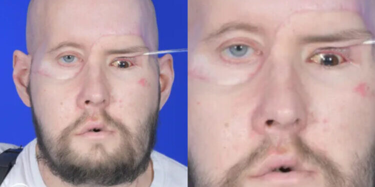 Realizan con éxito primer trasplante de ojo completo en el mundo