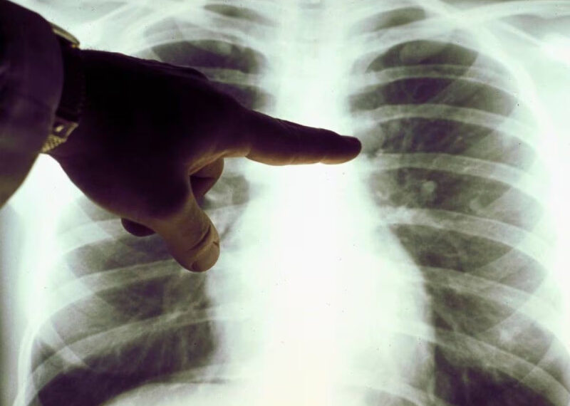 Estudio señala que la contaminación del aire promueve el cáncer de pulmón  en no fumadores - La Consulta Medica